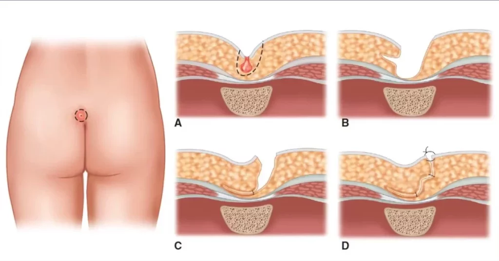 علاج الناسور العصعصي بالليزر