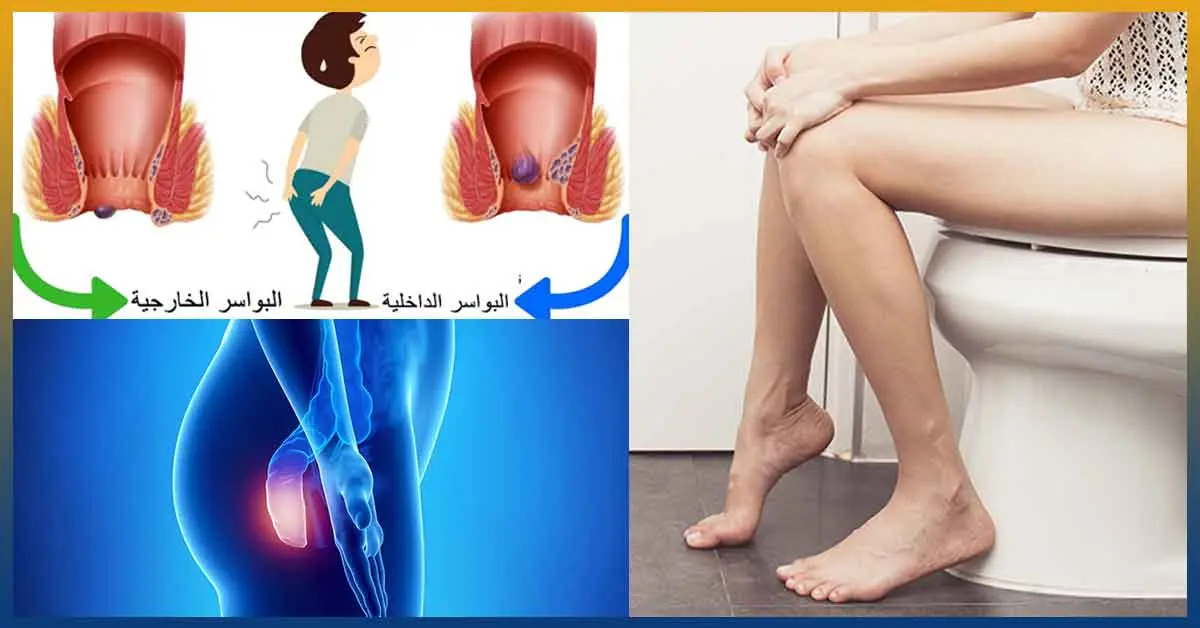 عملية البواسير بالليزر