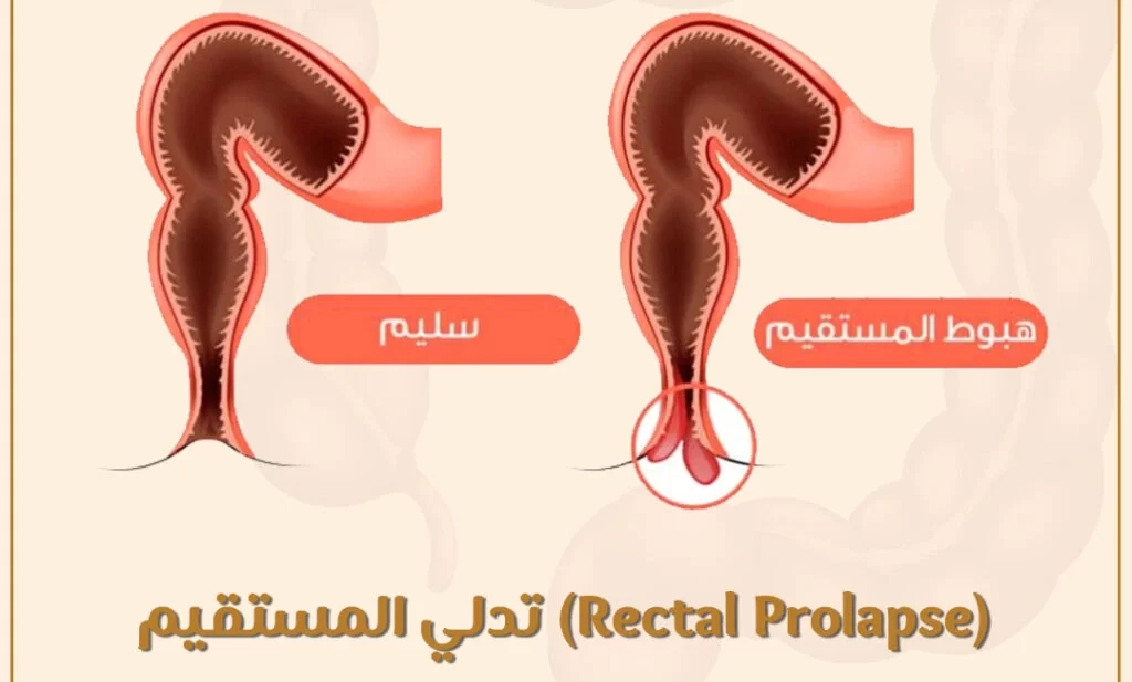السقوط الشرجي